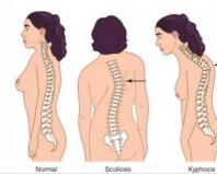 Cколиоз у детей: как вылечить заболевание